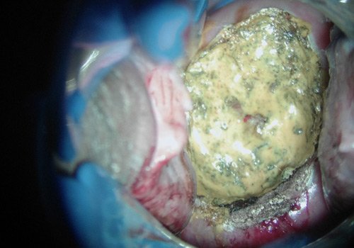 Dr. Jorge Ojeda Ortiz Cirugía Oncológica y Ginecológica en Pachuca, Hidalgo Experto en Detección y Tratamiento de Cáncer Mamario y Cervicouterino