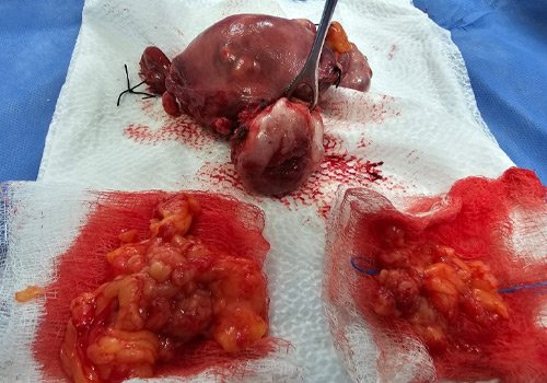 Dr. Jorge Ojeda Ortiz Cirugía Oncológica y Ginecológica en Pachuca, Hidalgo Experto en Detección y Tratamiento de Cáncer Mamario y Cervicouterino